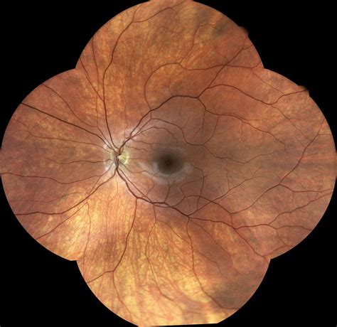 What Does Eyes Dilated Look Like at Brianna Conley blog