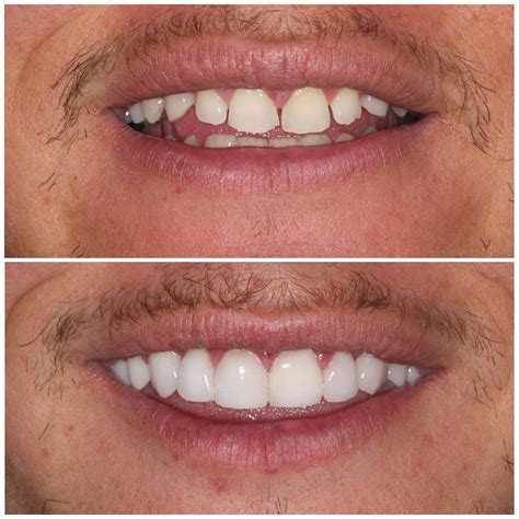 Teeth Veneers Before And After