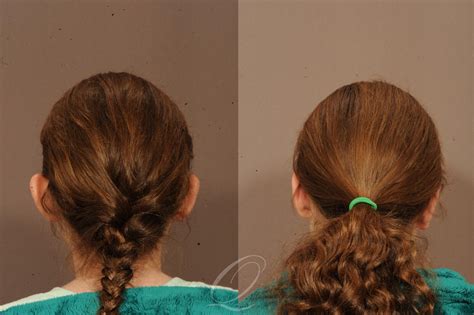 Otoplasty (Ear Pinning) Before & After Photos Patient 1001588 | Serving Rochester, Syracuse ...