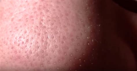Clogged Pore On Nose