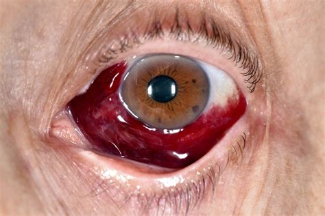 Subconjunctival Hemorrhage - Eye Disorders - Merck Manual Consumer Version