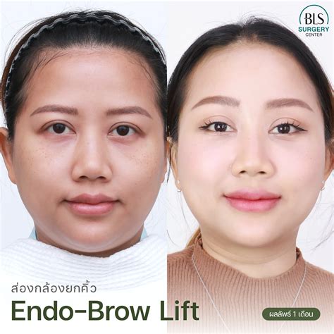 หมอบีม & หมอเอิร์ธ คว้ารางวัลเลิศ 'The Best Endoscopic Brow Lift
