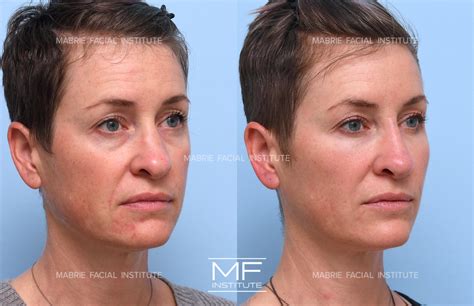 Nasolabial Fold Treatment With Filler & BOTOX® in the San Francisco Bay Area – Mabrie Facial ...