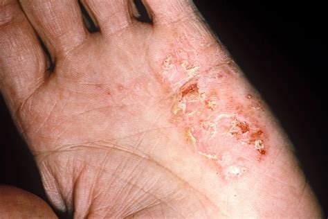 eczema: qué es, síntomas, causas, tipos y tratamiento | Guía de salud | Vidaliax