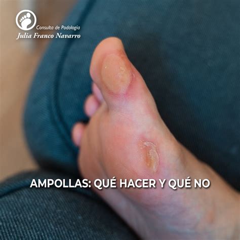 Ampollas en los pies: cómo tratarlas y cuándo acudir al podólogo - Consulta de Podología Julia ...