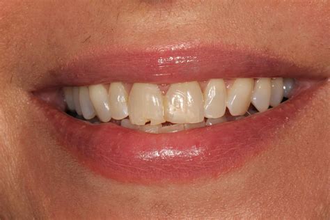 Cosmetic Dentistry: Bonding A Broken Front Tooth