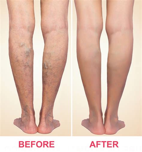 Sclerotherapy (spider Veins) | Sima Medical & Cosmetic Clinic | Woodinville