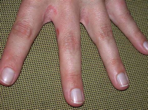 Contact Dermatitis On Nails