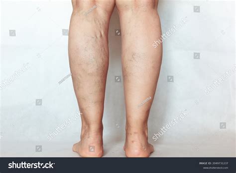 12,032 Varicose Veins Images, Stock Photos & Vectors | Shutterstock
