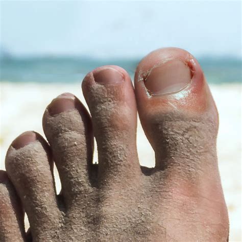 Toenail Avulsion Procedure at Victoria Sanchez blog