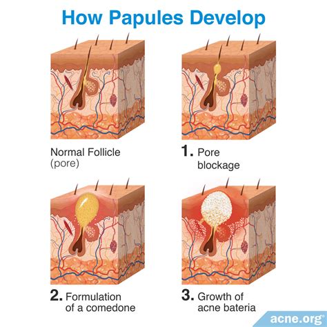 Papules And Pustules