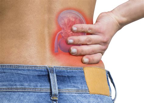 UF Health Launches NIH-Sponsored Trial to ‘POuND OUT’ Painful Kidney Stones » Department of ...