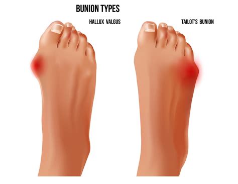 Understanding Tailor’s Bunion: Causes, Symptoms, and Treatment | Blog | Gotham Footcare