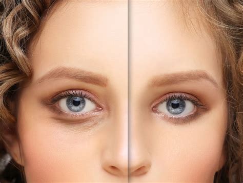 All Your Answers On How To Fix Sunken Eyes | Lumière Clinic
