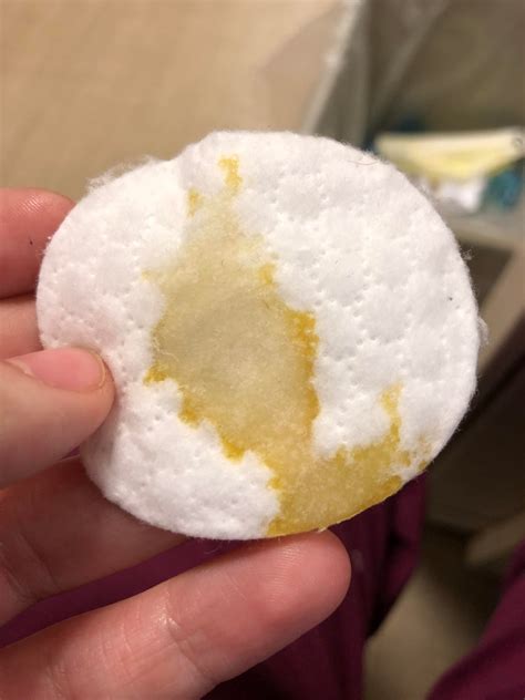 Has anyone else experienced Eczema on their nipple(s)? I've been ...