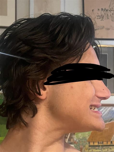 Another angle of my face for what I believe is short face syndrome : r/jawsurgery