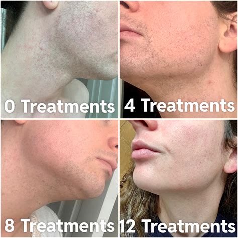 Laser hair removal facial hair online