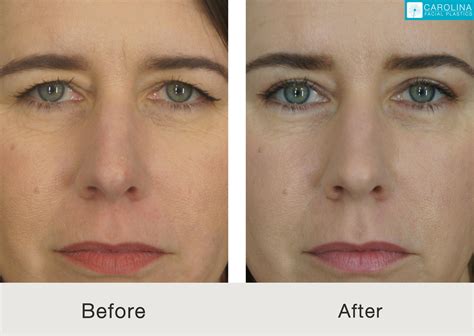 Plastic Surgery Endoscopic Brow Lift at Claire Ryder blog