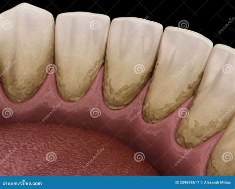 What Is Tartar On Teeth Made Of at Virginia Ertel blog