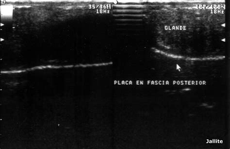 Enfermedad de Peyronie