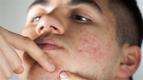 The Risks of Popping Your Pimples - GoodRx