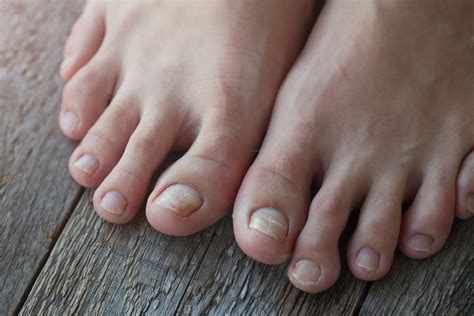 Why Are My Toenails Dark And Thick - Design Talk