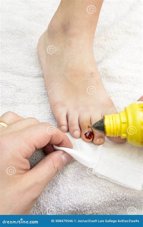 Detail of an Injury To a Child S Toenail Stock Photo - Image of injury ...