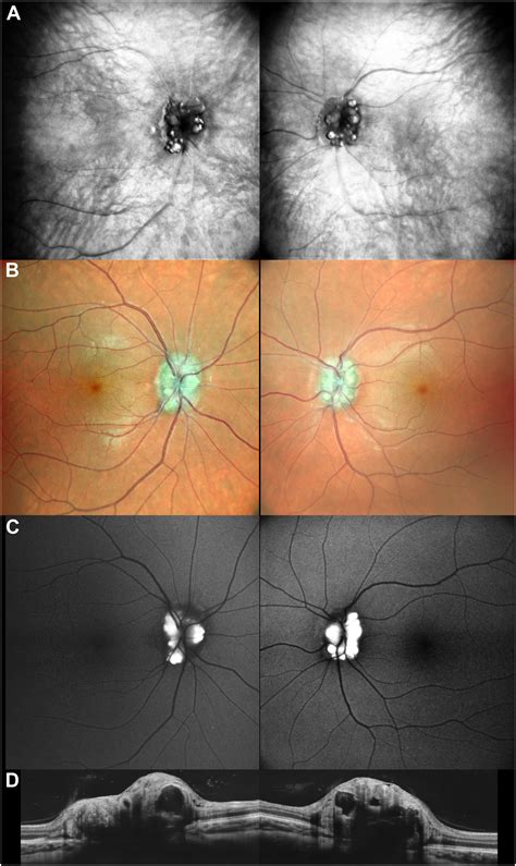 Interest of Retromode Imaging in the Visualization of Optic Nerve Head Drusen - Ophthalmology