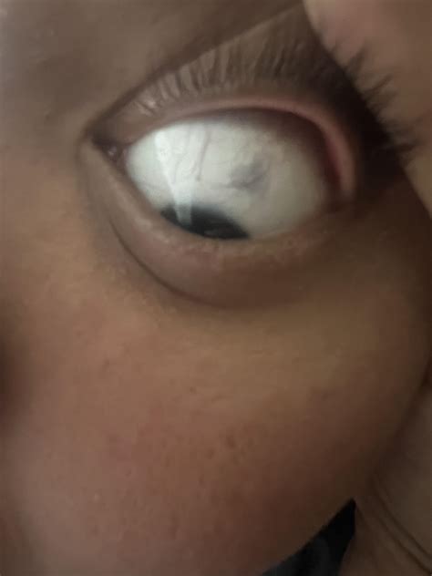 Grayish spot on white part of eye : r/eyedoctors