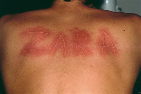Urticaria Skin Writing