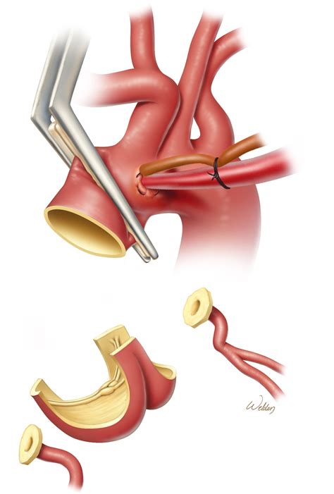 Straightforward Contemporary Step-by-Step Approach to Aortic Root Replacement With Valve-Sparing ...