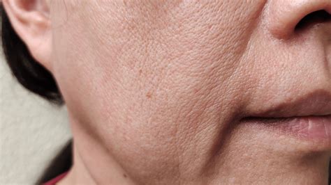 How To Get Rid of Smile Lines | Harley Street Dermal