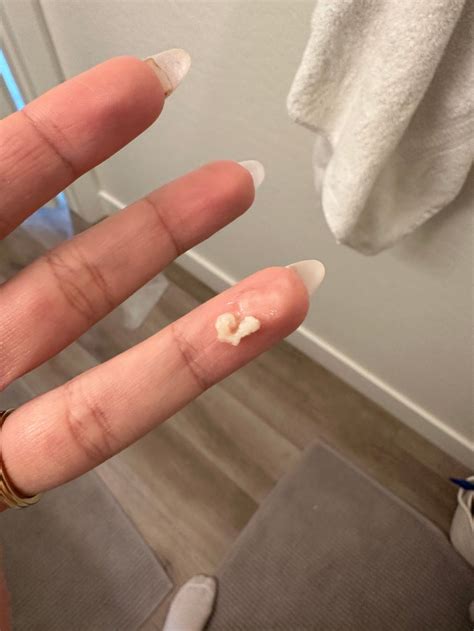 Early Pregnancy Discharge