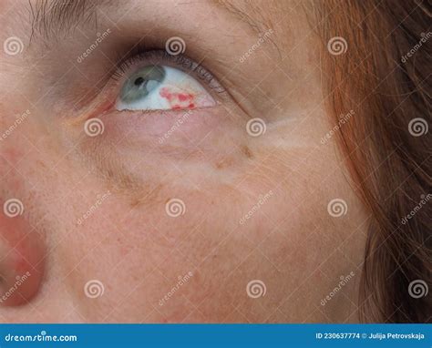 Subconjunctival Hemorrhage or Subconjunctival Bleeding, Hyposhagmus. Bleeding Under the ...