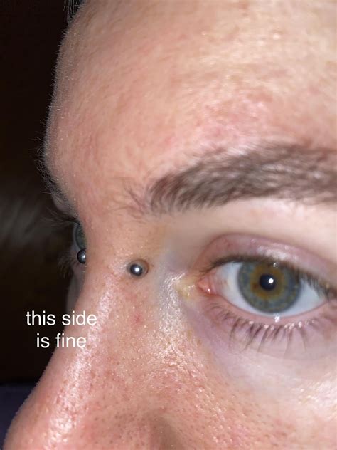 One side of bridge piercing (pierced mid-october) started developing ...