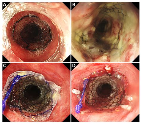 Successful Treatment of an Esophago-Tracheobronchial Fistula Using Double Stenting to Correct ...