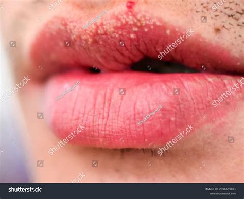 White bumps on lips : 96 images, photos de stock, objets 3D et images ...