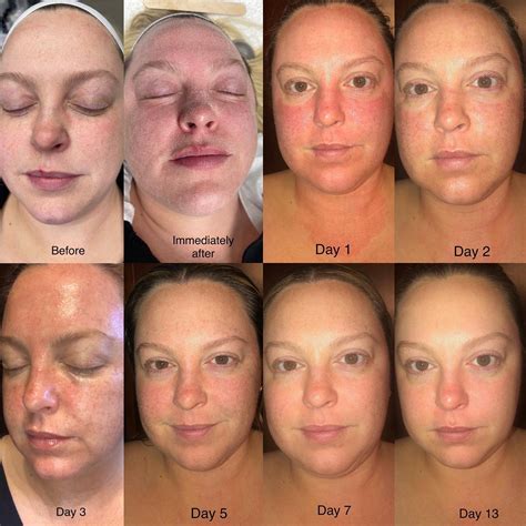 CO2 Laser Hanford: The Ultimate Solution for Skin Imperfections - Excellence Medical Spa