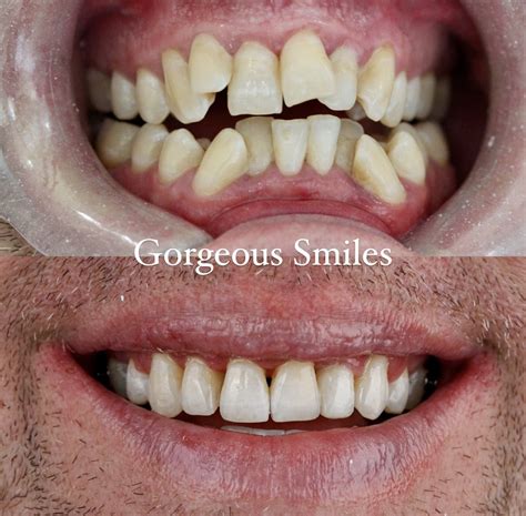 Crooked Teeth With Braces Before And After
