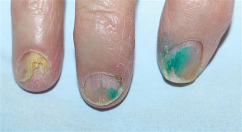 What Causes Green Under Fingernails at Luke Earsman blog