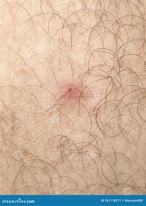 Cicatriz En El Cuerpo Humano Imagen de archivo - Imagen de primer ...