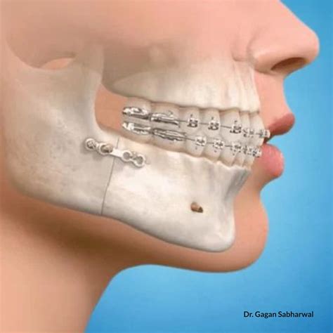 Orthognathic Jaw Surgery UAE | Expert Jaw Reconstruction