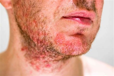 Umgang mit seborrhoischer Dermatitis - MedDe