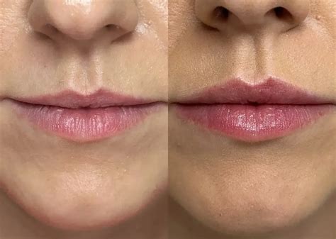 Lip Flip Before and After - Before After Journey
