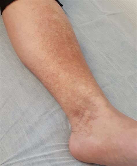 Lesiones hiperpigmentadas crónicas en miembros inferiores. A propósito ...