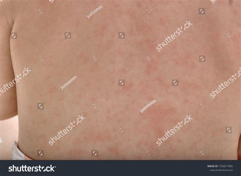341 imagens de Criança com roseola Imagens, fotos stock e vetores ...