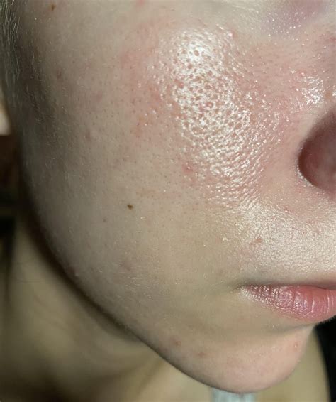 [Routine Help] Is my skin dehydrated? I’m at a loss. : r/SkincareAddiction