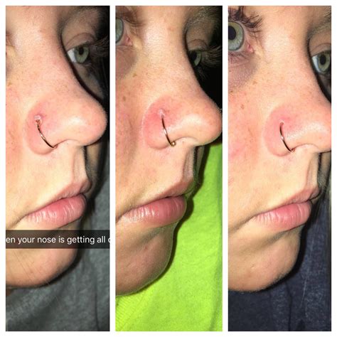 Bump On Nose Piercing