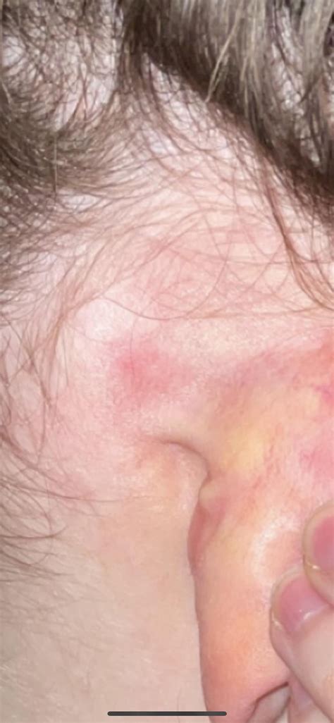 Lump behind ear : r/medical