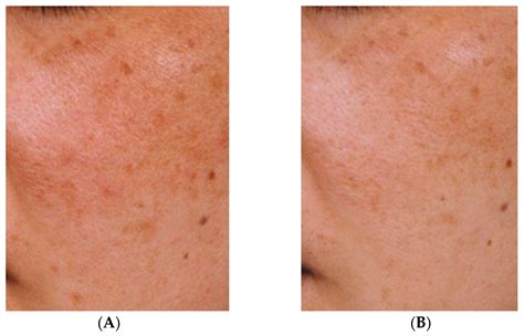Mechanism of Action of Topical Tranexamic Acid in the Treatment of ...